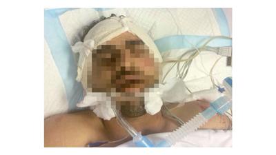 الجاني مصابا في العناية المركزة بعد تعرضه لحادث