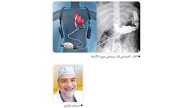 نجاح أول عملية زراعة قلب صناعي في الكويت