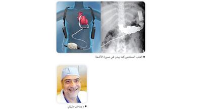 نجاح أول عملية زراعة قلب صناعي في الكويت