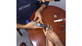 انحشار أصبع طفلة في حلقة خرطوم مياه