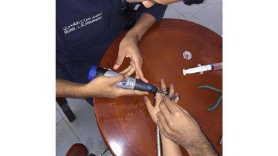 انحشار أصبع طفلة في حلقة خرطوم مياه