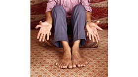 صورة- المحظوظ الذي لديه 28 اصبعا