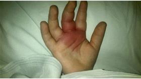 بالصور - لدغة عنكبوت تسببت فى شلل لطفل في الثانية من عمره