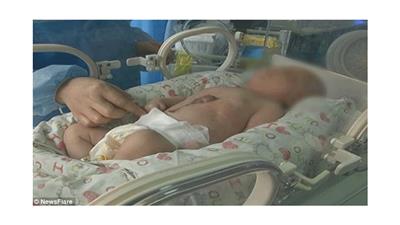 بالفيديو - لحظات مؤثرة لطفل ولد بقلب خارج بطنه