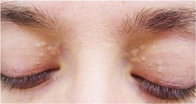 علامتان في الوجه تكشفان عن ارتفاع مستوى الكوليسترول