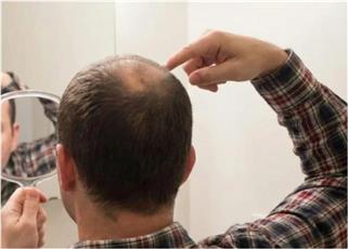 اختراق طبي جديد.. أول علاج موضعي للصلع يعيد نمو الشعر